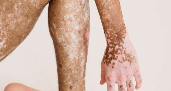 What Is Vitiligo and It's Beauty?